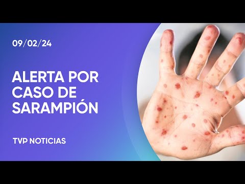 Alarma por un caso de sarampiÃ³n en Buenos Aires