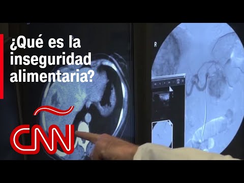 Esta es la enfermedad vinculada al hígado graso que afecta a menores latinos en EE.UU.