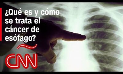 ¿Qué es y cómo se trata el cáncer de esófago?