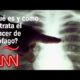 ¿Qué es y cómo se trata el cáncer de esófago?