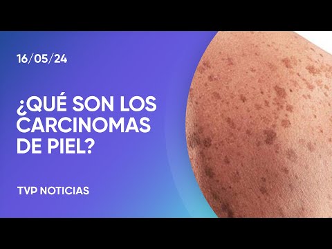 ¿Qué son los carcinomas de piel?