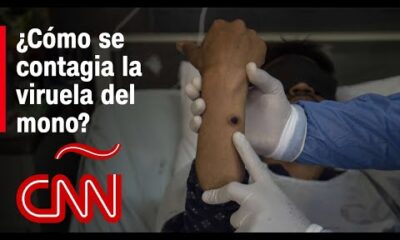 ¿Cómo se contagia la viruela del mono (mpox), que fue declarada emergencia internacional por la OMS?