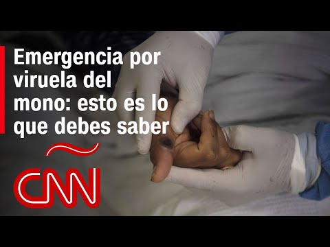 ¿Qué es la viruela del mono, cuáles son sus síntomas y por qué fue declarada emergencia por la OMS? ¿Qué es la viruela del mono, cuáles son sus síntomas y por qué fue declarada emergencia por la OMS?