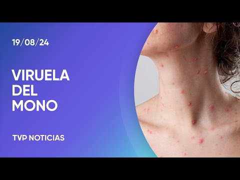 Viruela del mono: al menos 8 casos en el país Viruela del mono: al menos 8 casos en el país