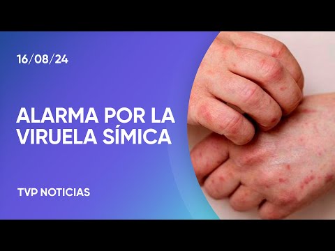 Viruela símica: emergencia internacional y casos locales