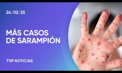 Confirmaron el cuarto caso de sarampión en CABA