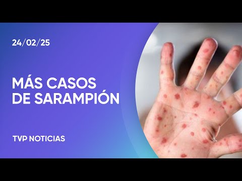 Confirmaron el cuarto caso de sarampión en CABA